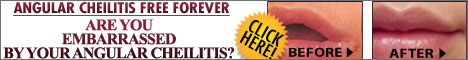 Angular Cheilitis Free Forever