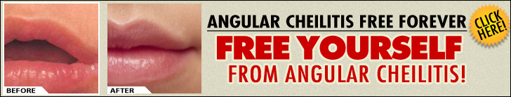 Angular Cheilitis Free Forever