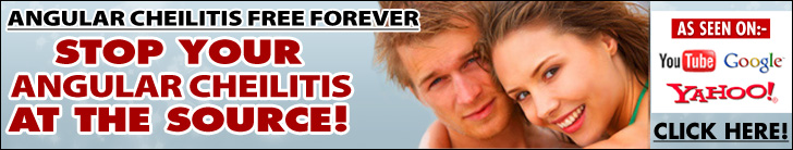 Angular Cheilitis Free Forever