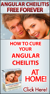 Angular Cheilitis Free Forever