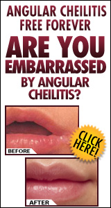 Angular Cheilitis Free Forever