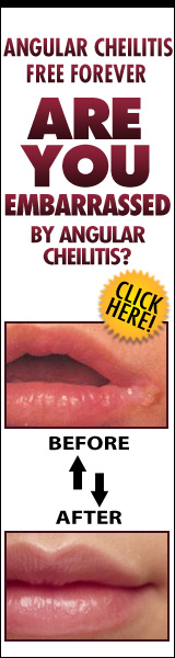 Angular Cheilitis Free Forever