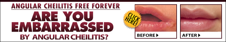 Angular Cheilitis Free Forever